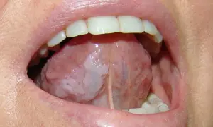 Lingua con aree bianche indicative di leucoplachia, potenziale segno precoce di tumore alla lingua.