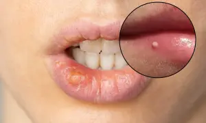 Ingrandimento di labbra con herpes e piccoli puntini bianchi.