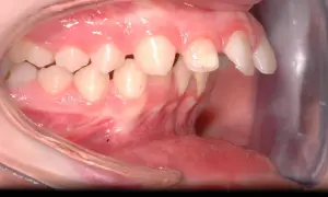 Denti superiori sporgenti e inferiori retratti, un caso di malocclusione 2 classe adulto.