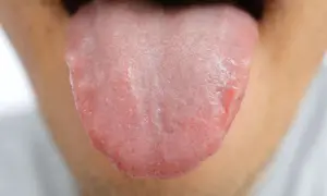 Lingua arrossata e irritata, con piccole vescicole, che suggeriscono un bruciore alla lingua.