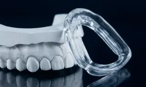 Modello dentale e bite trasparente, soluzione per il bruxismo consigliata dal dentista.