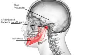 Illustrazione anatomica del cranio che evidenzia l'articolazione temporo-mandibolare, la mandibola (in rosso) e l'osso temporale. Utile per comprendere la disfunzione temporo mandibolare.