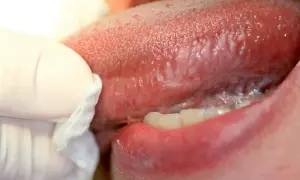 Lingua con lesioni orali, alcune papille gustative appaiono gonfie e arrossate. Un guanto bianco con garza pulisce delicatamente la zona.