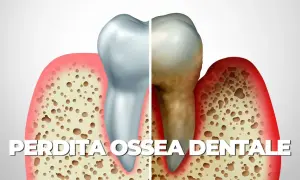 Illustrazione di un dente sano e uno malato, con osso alveolare che mostra riassorbimento osseo alveolare diffuso di tipo orizzontale e verticale.