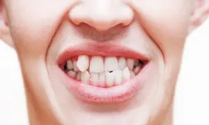 Primo piano di una bocca con labbra arrossate e denti bianchi, alcuni leggermente storti, che sembrano battere per il freddo o la tensione.