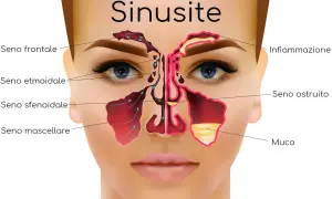 Illustrazione anatomica della sinusite, con enfasi sulla sinusopatia mascellare, mostrando infiammazione e accumulo di muco nei seni paranasali.