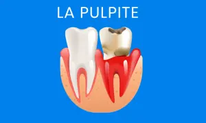 Dente sano a sinistra, dente cariato e infiammato a destra, con la scritta "LA PULPITE" in alto.