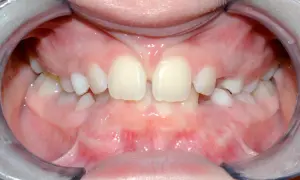 Bocca aperta con denti da latte e il frenulo labiale superiore visibile tra gli incisivi centrali.