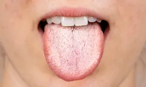 Bocca aperta con lingua che mostra una patina biancastra, quasi una lingua verde per la sua opacità.