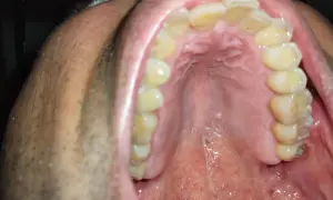 Vista ravvicinata della bocca con denti ingialliti e una piccola cisti sul palato.