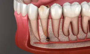 Dente cariato con radice infetta, pronto per l'estrazione. La durata estrazione dente dipende dalla complessità.