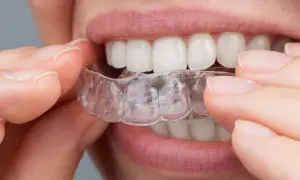 Dita che posizionano un apparecchio invisibile sui denti bianchi.