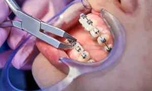 Un dentista usa pinze per sistemare i brackets ortodontici su un dente.