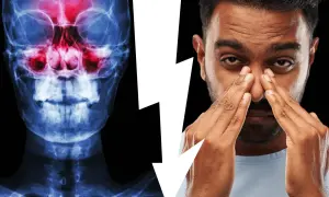 Radiografia dei seni paranasali con infiammazione e uomo che si tocca il naso, suggerendo un problema di sinusite odontogena e la necessità di un intervento.