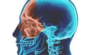 Anatomia del cranio in sezione, evidenziando i seni mascellari in arancione. Utile per comprendere la sinusite mascellare odontogena e i suoi rimedi.