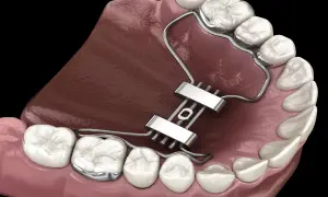 Dettaglio di un espansore palatale metallico applicato ai denti superiori per correggere la mascella.