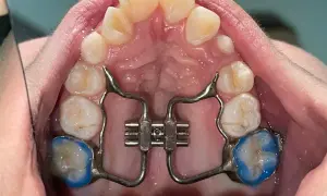 Espansore palato bambini costo: apparecchio ortodontico per allargare il palato, con placchette blu sui molari.