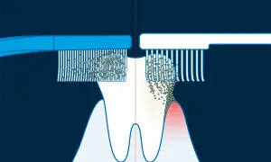 Illustrazione della tecnica di Bass: spazzolino a sinistra pulisce bene, a destra mostra accumulo di placca e gengiva infiammata.