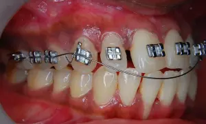 Primo piano di denti con apparecchio fisso. Impossibile togliere l'apparecchio fisso da soli.