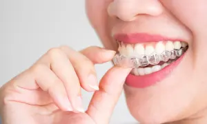 Dettaglio di una bocca con un apparecchio estetico trasparente, che corregge i denti per un sorriso perfetto.