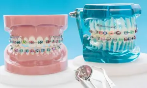 Modelli di denti con apparecchi ortodontici e elastici colorati. Strumenti dentistici in primo piano.