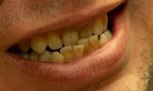 Primo piano di una bocca con denti ingialliti e disallineati, indicativi di una malocclusione di terza classe.