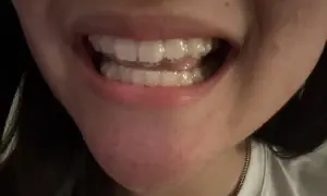 Primo piano di una bocca con apparecchi invisibili e chewies Invisalign per un sorriso perfetto.