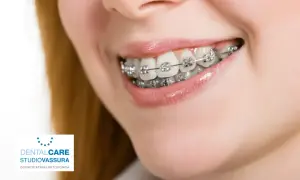Sorriso con apparecchio ortodontico. L'ortodonzia, il cui significato è allineare i denti, migliora l'estetica e la salute orale.