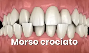 Denti con morso incrociato, una condizione che necessita di correzione ortodontica.