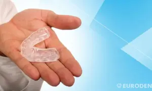Mano che tiene un bite apparecchio trasparente, utile per proteggere i denti durante il sonno o lo sport.