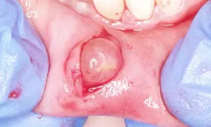 Gloved hands retracting tissue to reveal a translucent, rounded lesion on the gum, likely a fibroma orale.