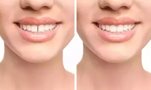 Prima e dopo: il diastema, uno spazio tra i denti, viene corretto per un sorriso perfetto.