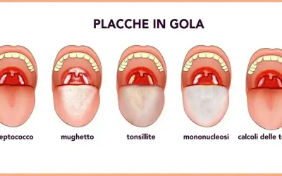 Illustrazione di diverse condizioni della gola, tra cui placche, mughetto e tonsillite, utili per comprendere i rimedi naturali per le placche in gola.