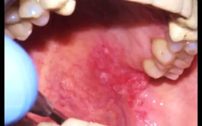 Lingua infiammata con lesioni, strumento medico vicino. La biopsia lingua è dolorosa.