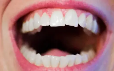 Bocca aperta con denti bianchi e ravvicinati, un esempio di affollamento dentale.