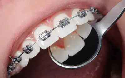 Dettaglio di denti con apparecchio ortodontico metallico. Un piccolo specchietto riflette i denti, mostrando come si mette l'apparecchio.