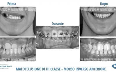 Prima e dopo un trattamento ortodontico per correggere una malocclusione dentale e problemi neurologici correlati.