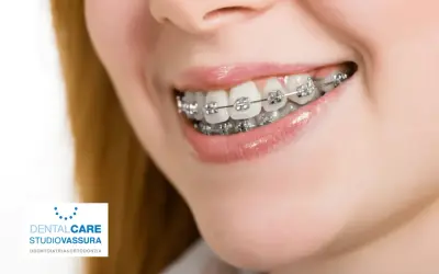 Sorriso con apparecchio ortodontico. L'ortodonzia, il cui significato è allineare i denti, migliora l'estetica e la salute orale.