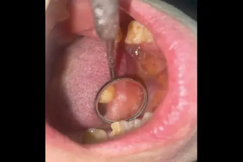 Area bianca sulla guancia interna, possibile leucoplachia. Esame dentistico in corso.