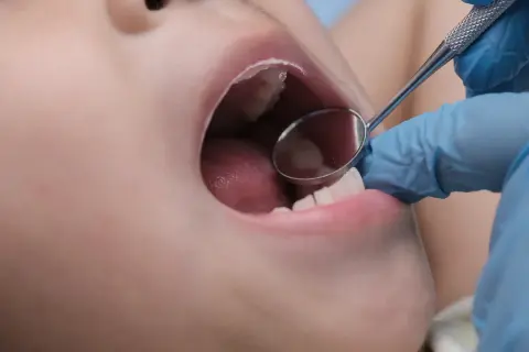 Esame dentistico: un piccolo specchietto riflette la bocca aperta di un bambino, mostrando la lingua e alcuni puntini sul palato.