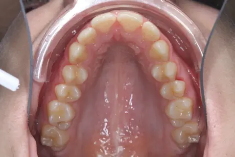 Vista interna della bocca con denti superiori e palato. Si nota un leggero mento retratto, con un divaricatore che espone l'arcata dentale.