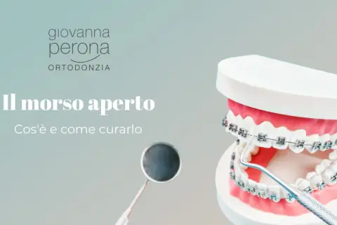 Modello di denti con apparecchio ortodontico mostra un morso aperto. Un dentista esamina il caso.