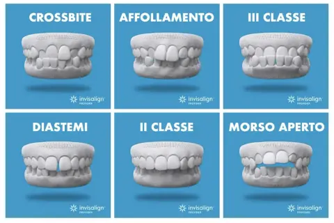 Modelli di denti con problemi: crossbite, affollamento, III classe, diastemi, II classe, morso aperto. Soluzioni Invisalign per correggere.