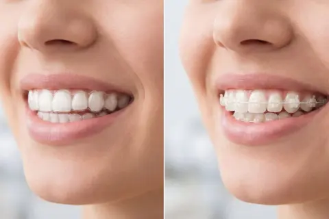 Primo piano di un sorriso con apparecchio trasparente e poi con apparecchio fisso.