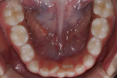 Vista ravvicinata della bocca di un adulto con denti sani, alcuni con piccole bollicine. Si nota una leggera sovrapposizione di alcuni denti, suggerendo una possibile necessità di correzione ortodontica per i denti doppia fila adulti.