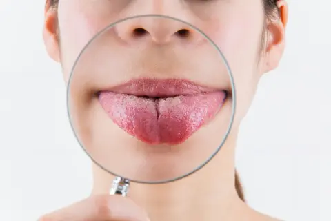 Primo piano di una bocca con una lente d'ingrandimento che mostra una lingua con una profonda fessura centrale, una lingua spaccata.