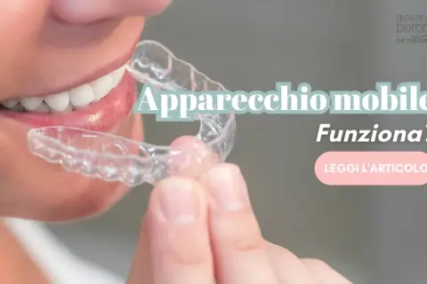 Dente allineato con un apparecchio mobile trasparente. Scopri se funziona davvero.