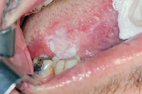 Lesione bianca sulla lingua, in attesa di biopsia escissionale.