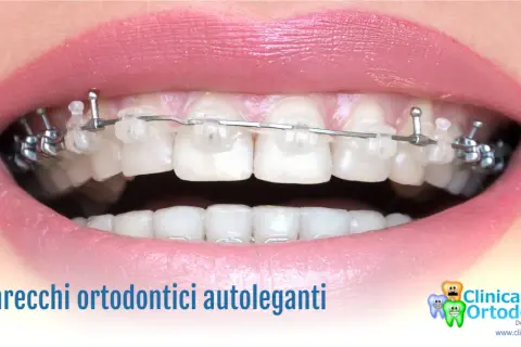 Primo piano di un sorriso con apparecchio autolegante trasparente e metallico.