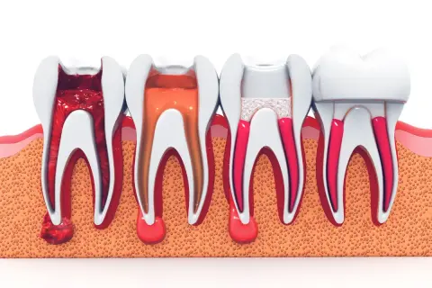 Illustrazione di un dente devitalizzato: dalla polpa infiammata alla sigillatura dei canali radicolari.